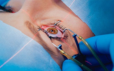 (Femto-Lasik) فمتولیزیک