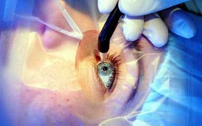 (LASIK) لیزیک 